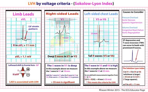 minimal voltage criteria for lvh|Left ventricular hypertrophy .